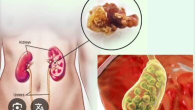 पथरी कारण एवं निवारण ,